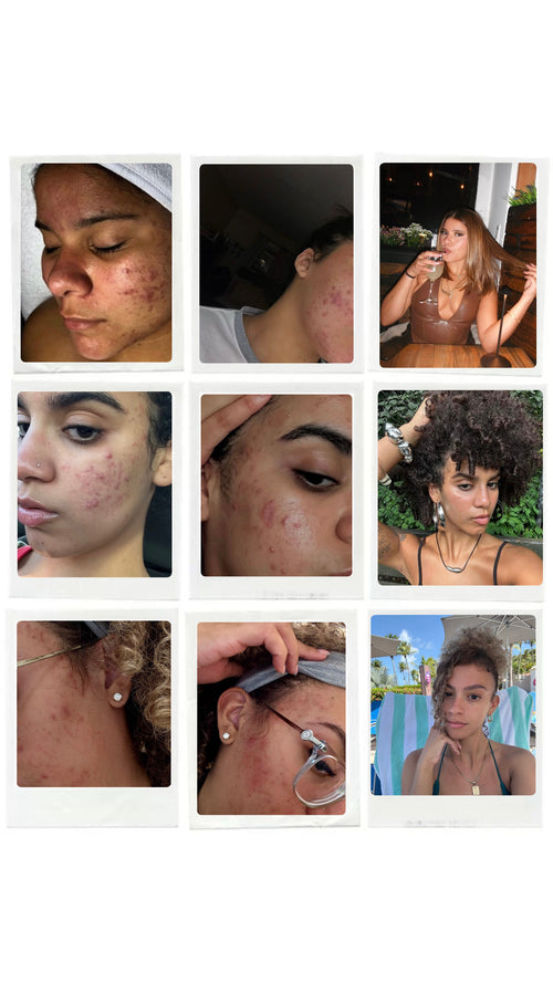 VIRTUAL PROGRAM — 6 MONTHS
VIRTUAL SKIN COACHING